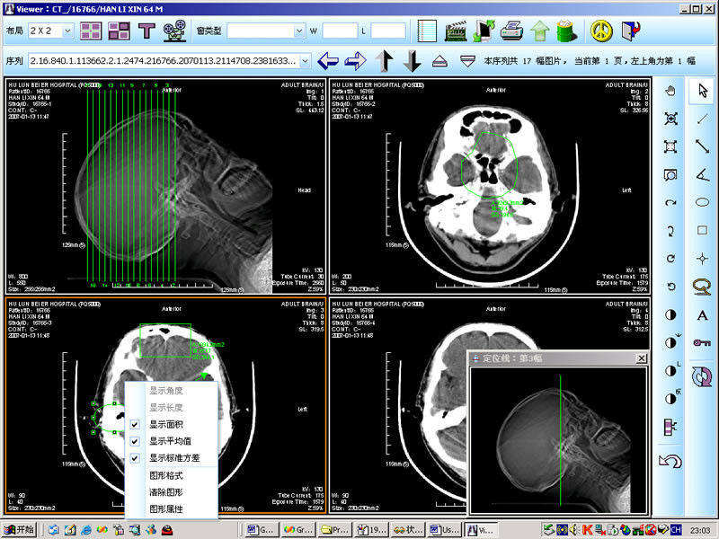8 rappresentazione diagnostica medica del laser X Ray della carta di x 10inch per KND-DRYTEC 4000