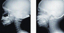 Alta rappresentazione diagnostica di copertura X Ray dell'inchiostro, lastra radioscopica medica del laser di 43cm x di 35