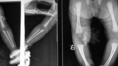 Good price imaging biomedico del laser X Ray di 25cm x di 20, lastra radioscopica DT2B/di DT1B Agfa in linea