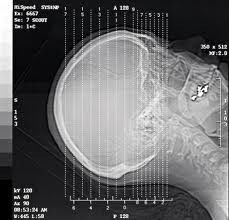 Good price La rappresentazione diagnostica d'argento del laser X Ray dell'alogenuro, A3/A4 impermeabilizza il film della trasparenza in linea