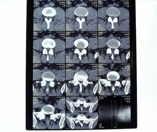 Good price 8in* 10in film asciutto della stampante termica dei raggi x medici ad alta densità di 17in * di 14in in linea